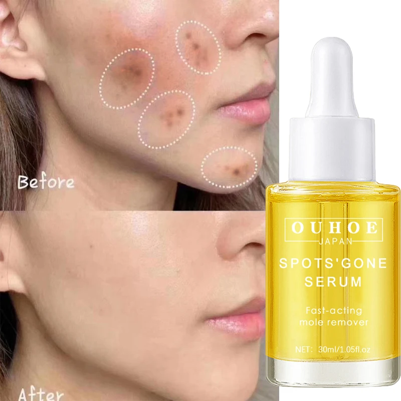 Whitening Freckles Face Serum Remove Melasma Dark Spots Lighten Melanin Acne Treatment Brightening Moisturizing Repair Skin Care