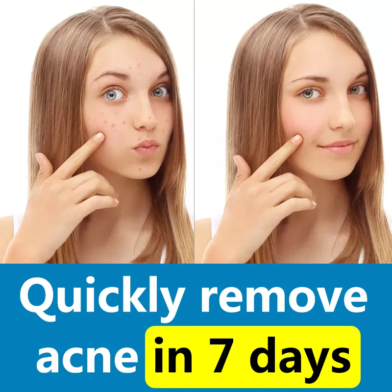 Быстрый крем от прыщей с увлажняющей гиалуроновой кислотой очищающее поры