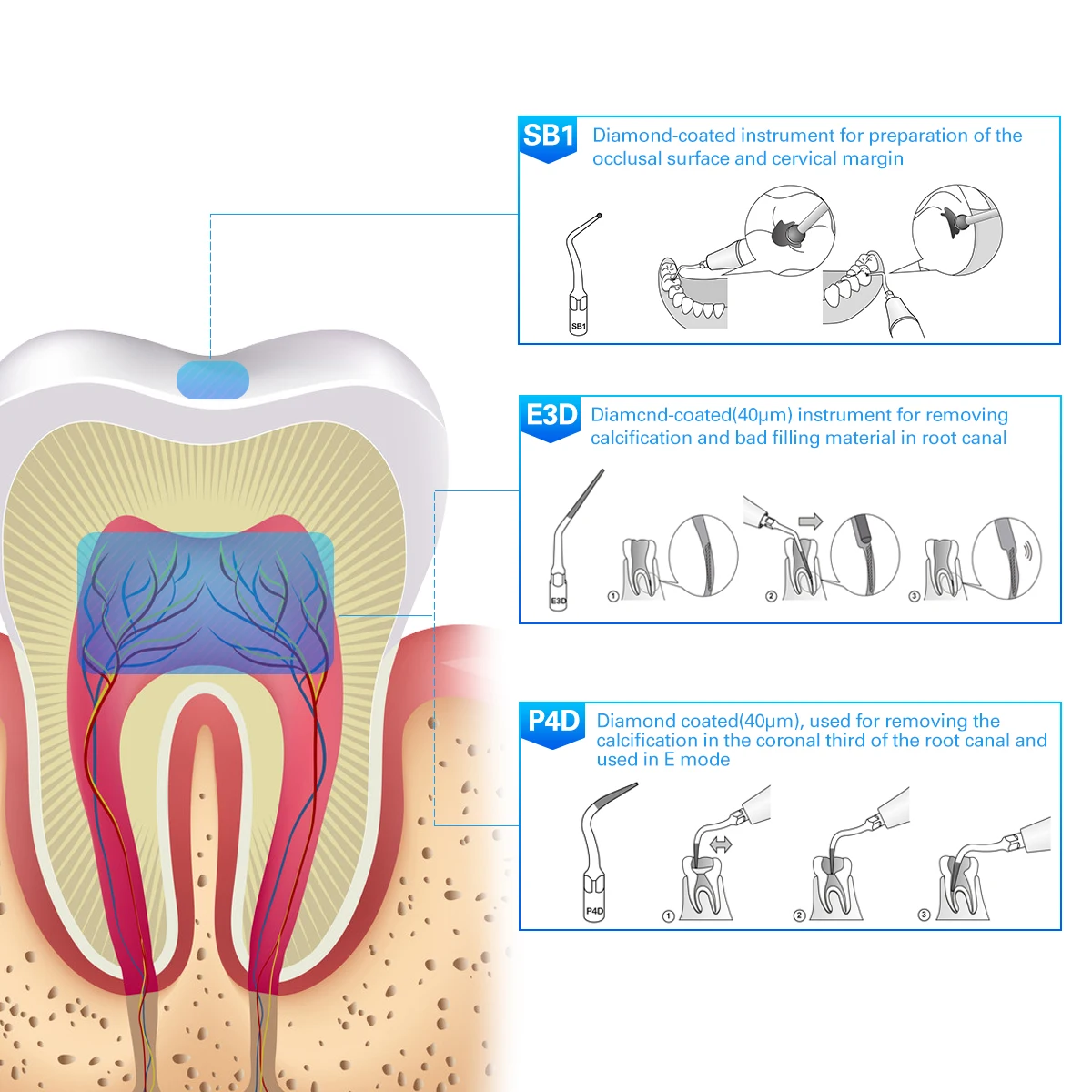 Стоматологический Ультразвуковой скалер наконечник для накидки периодонтика