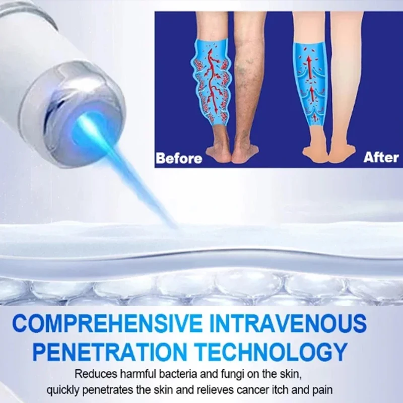 Leg Massage Body Repair Pen Lampshade Therapy For Varicose Veins Effective Relief Fatigue Improved Blood Circulation
