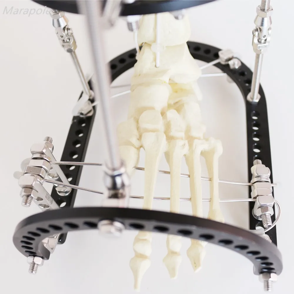 Ортопедический инструмент внешний фиксатор удлинение кости