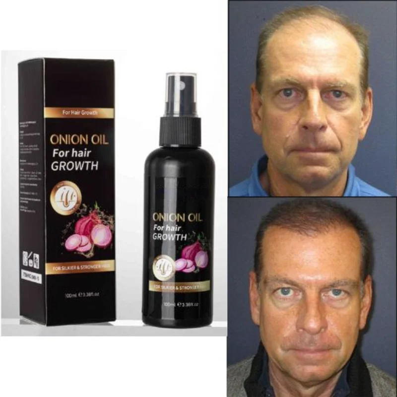 

Onion Oil Hair Growth and Anti-hair Loss Treatment Essential Oil Prevents Hair Loss Hair Growth Oil for Black Women