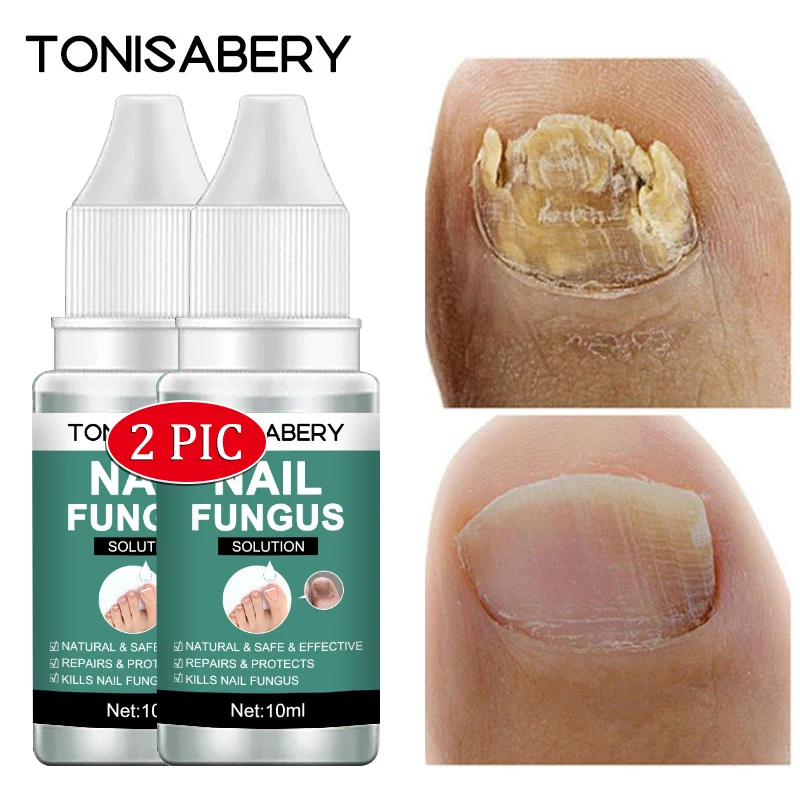 

2pcs Nail Fungal Treatment Essence Nail Fungus Anti Infection Cuticle Remover Serum Paronychia Onychomycosis Feet Care Products