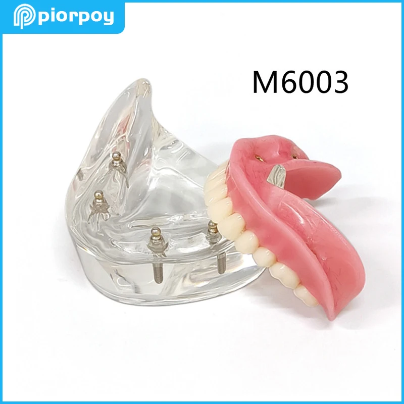 

4 Implants Dental Teaching Model Removable Overdenture Lower Inferior Restoration Typodont Teeth Models for Dentistry Demo M6003
