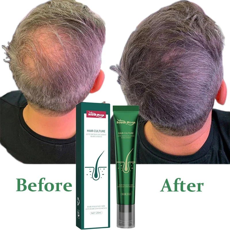 

Hair Growth Oil Fast Hair Growth Effective Treatment for Baldness Hereditary Hair Loss Postpartum Hair Loss Seborrheic Hair Loss