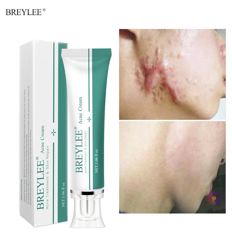 

Acne Scar Removal Cream Fade Pimples Scar Cosmetics Stretch Marks Treatment Whiten Moisturizing Skin Care Products Beauty Health