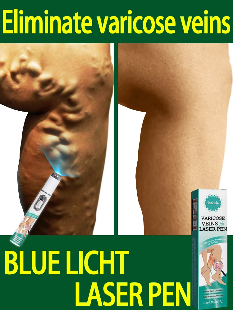 Крем-лазер Varicosse