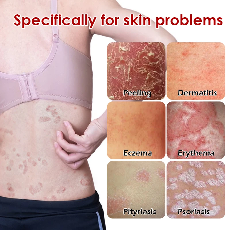 2 шт. антибактериальный крем для лечения псориаза