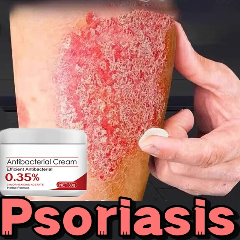 Формула Псориаз s Rash Eczema Tinea Cruris Dermatitis Papules Охлаждающий крем Бери-бери