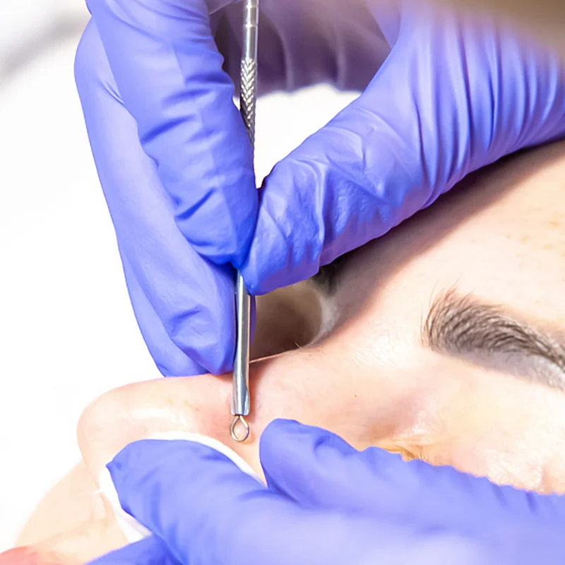 1/4 шт. инструменты для удаления чёрных точек на лице