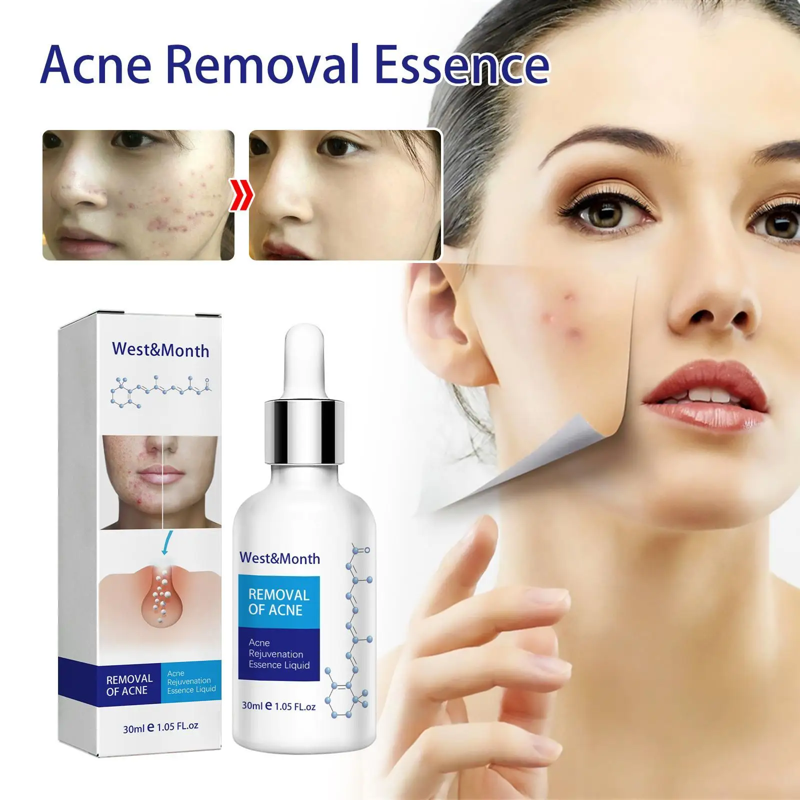 

Средство для лечения акне, средство для удаления рубцов, 30 мл, жидкость для удаления пятен от акне, уход за кожей лица, отбеливание, увлажнени...