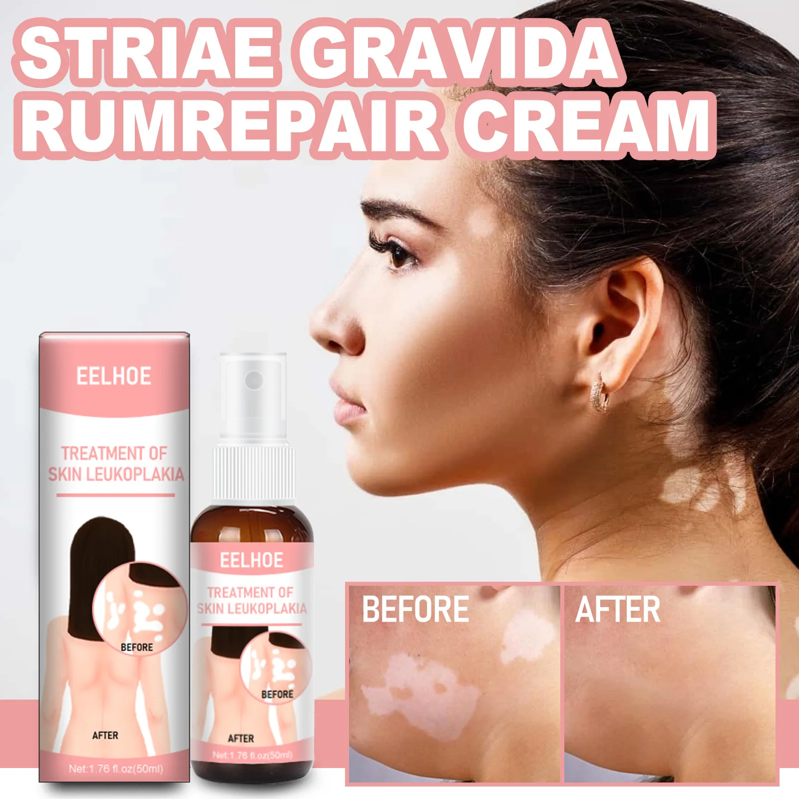 

50ML Vitiligo Treatment Spray Chinese Medical Pigment Melanin Promoting Liniment Skin White Spot Leukoplakia Disease Treatment