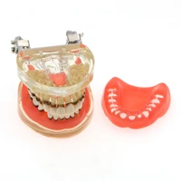 dental periodontal disease model adult teeth disease study teach model m4017