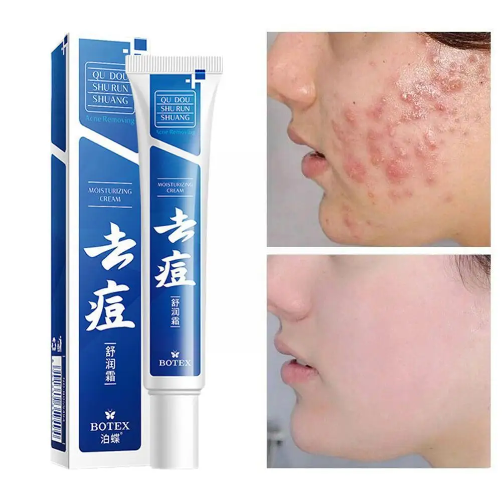 

Эффективный крем для удаления прыщей, 20 г, гель для лечения прыщей, ухода за кожей лица