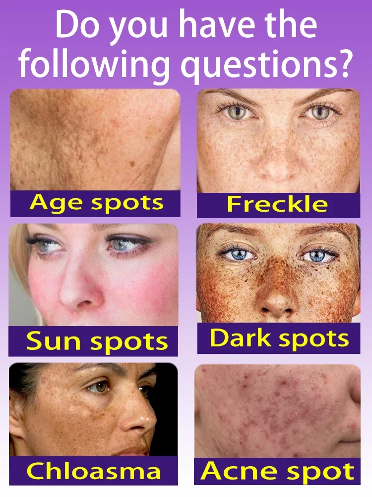 Sun Dark Age Spot Веснушки Прозрачные