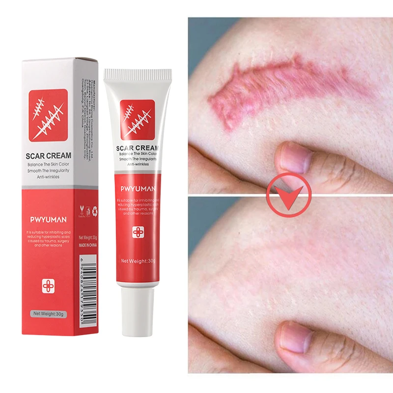 

Scar Removal Ointment Removal Stretch Marks Injury Scar Old Scar Removal Permanently Scars Treatment Eliminate Surgical Scar 30g