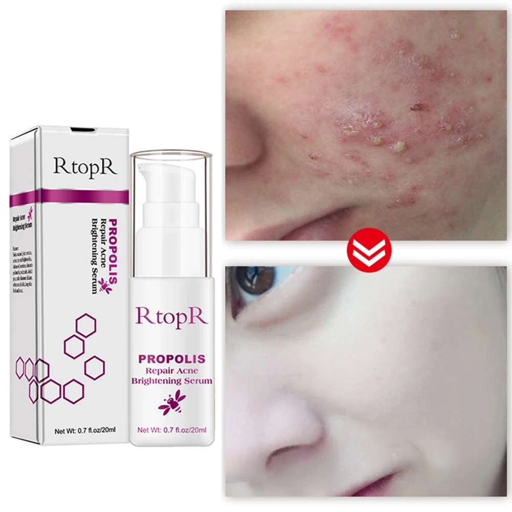 

1PCS Propolis Acne Removal Face Serum Hydrating Nourish Lighten Facial Skin Essence Firming Skin Shrink Pores Cosmetics Makeup