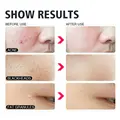 4pcs/set Professional Blackhead Remover Black Spot Pimple Blemish Beauty Women Skin Care Facial Cleaning Pimple Remover Tool Kit
