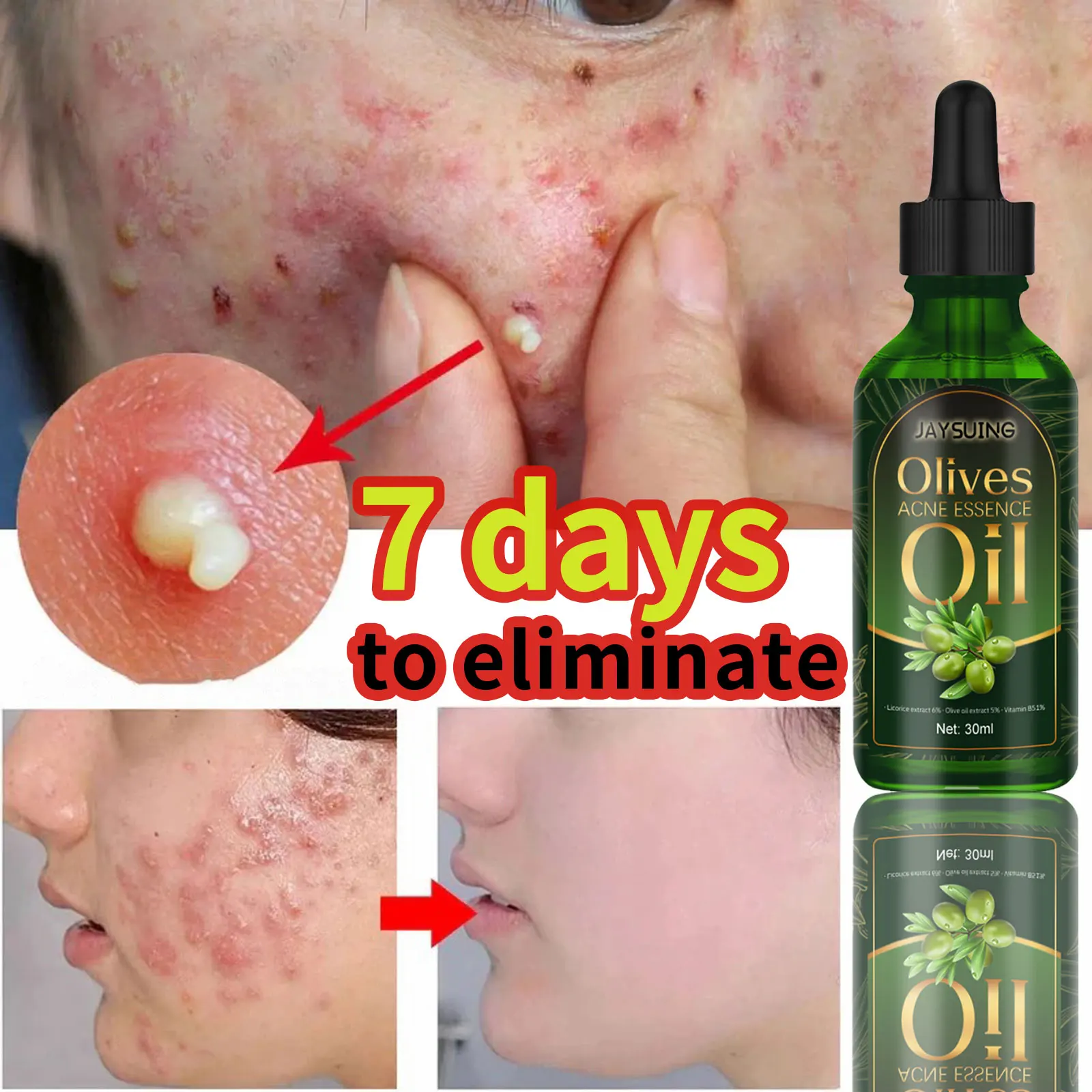 

Highly effective repair Acne control Blackhead removal Facial moisturiser Oily skin care For men and women