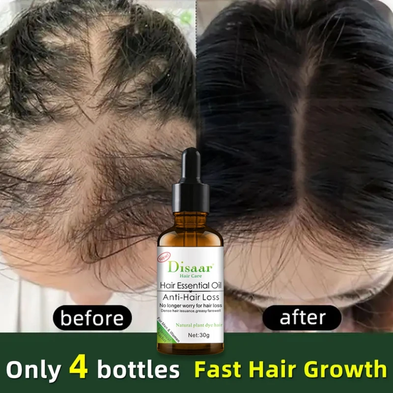 Hair Growth Plant Essence Oil Hair Follicle Fast Repair Anti-Hair Loss Regeneration Serum Baldness Scalp Treatment Care Products
