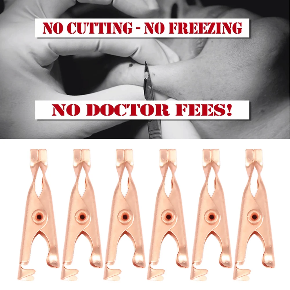 

2/6 шт., прищепки для удаления бородавок