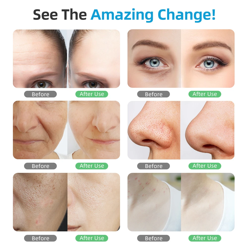 ZJKC 990 шт. силиконовая лампа для фототерапии лица 7 цветов светодиодная