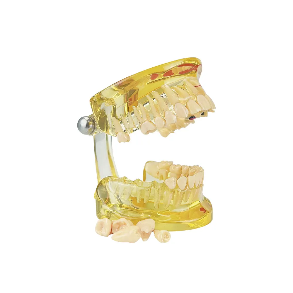 Модель для обучения стоматологии полусъемные зубы патологическая модель