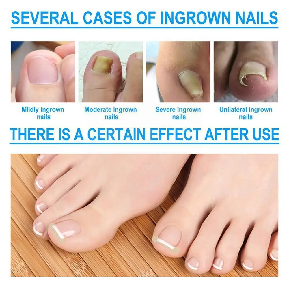

Nail Correction Stickers Waterproof Ingrown Toenail Tools Pedicure Recover Corrector Corrector HOT Treatment Paronychia Pat U8O5