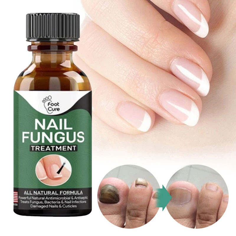 

10ml/20ml/30ml Nail Fungal Treatment Finger & Toenail Nail Repair Fungus Feet Care Essence Anti-Fungal Whitening Onychomycosis