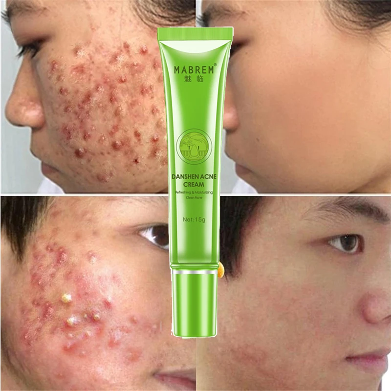 

Effective Acne Removal Cream Herbal Acne Spots Oil Control Acne Cream Skin Care Whitening Moisturizing Face Gel Skin Care 15g