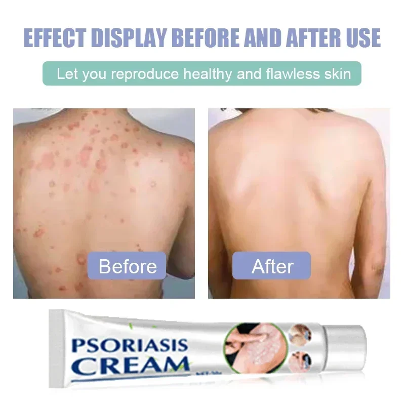 Увлажняющий крем от псориаза натуральный Восстанавливающий Антибактериальный