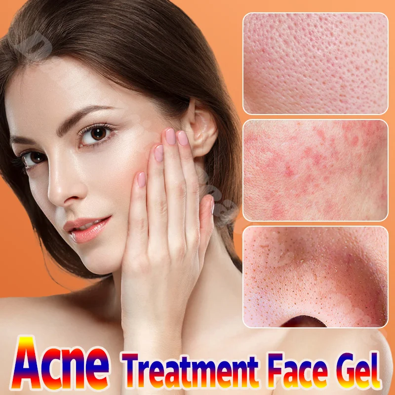 

Acne Removal Moisturizing Cream Effective Fade Acne Spots Repair Gel Oil Control Pimples Shrink Pores Acne Treatment Skin Care