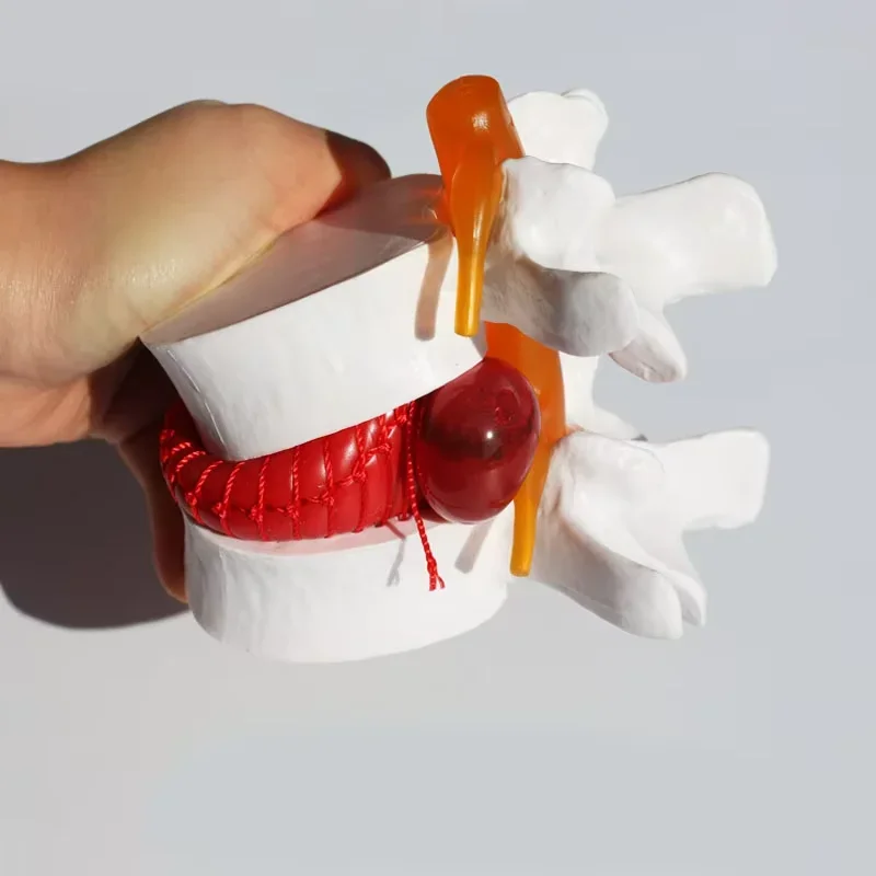 

Анатомическая модель грыжи поясничного диска ISHOWTIENDA