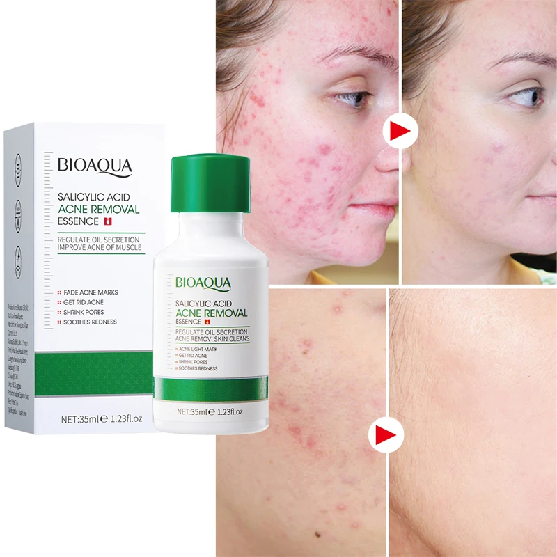 Acne Treatment Facial Essence Salicylic Acid Acne Removal Scar Removal Shrink Pores Serum Oil Control Moisturizing Skin Care 35g