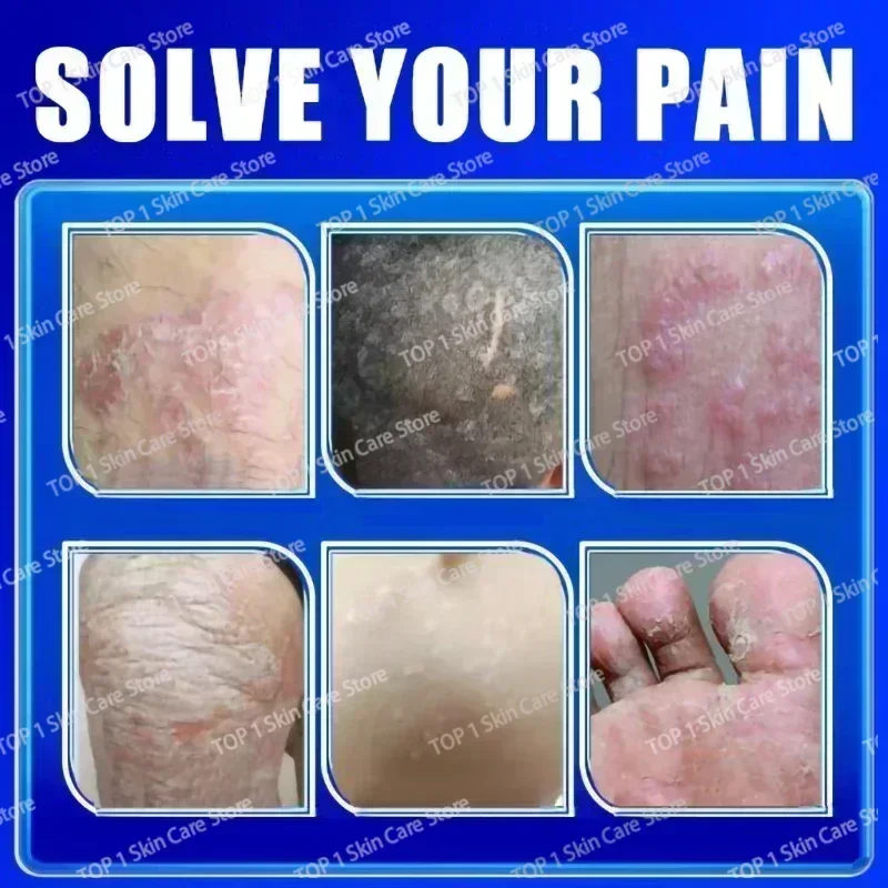 Лидер продаж крем для удаления псориаза экземы лучшие средства против дерматита