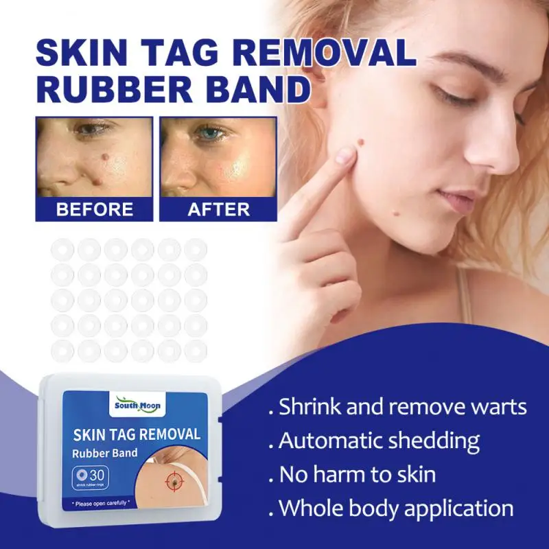 

30pcs Removing Warts Removing Flesh Moles Face Care Skin Tag Rubber Bands Wart Removal Rubber Bands Removal Micro Skin Tag