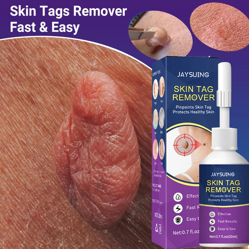 

Skin Tag Wart Remover Essential Oils Painless Mole Dark Spot Flat Wart Treatment Skin Labels Papilloma Genital Beauty Body Care