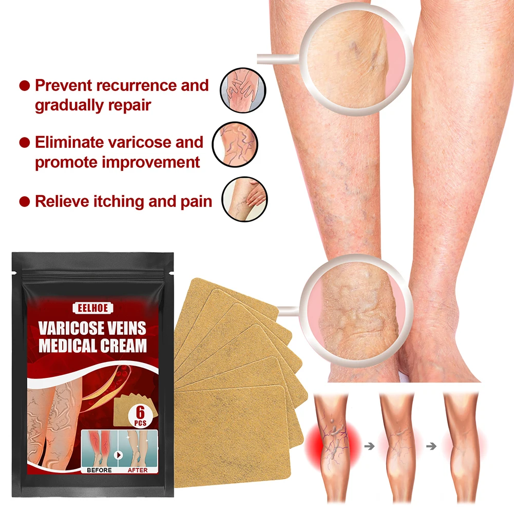 

12pcs Varicose Veins Plaster Traditional Herbal Vasculitis Phlebitis Cream Leg Pain Relieve Patch Angiitis Removal Patch