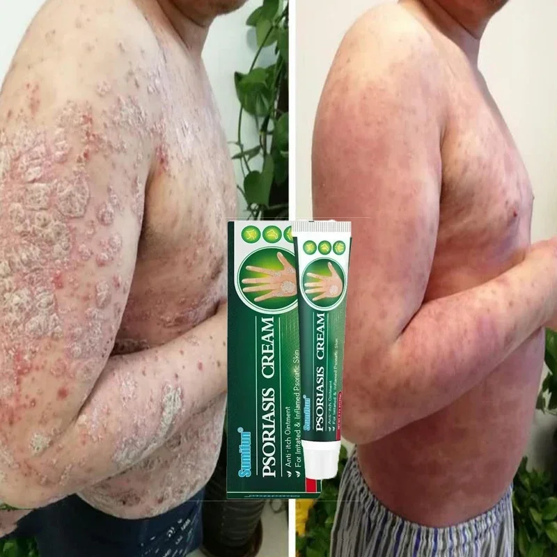 Крем для лечения псориаза антибактериальный против зуда дерматита экземы