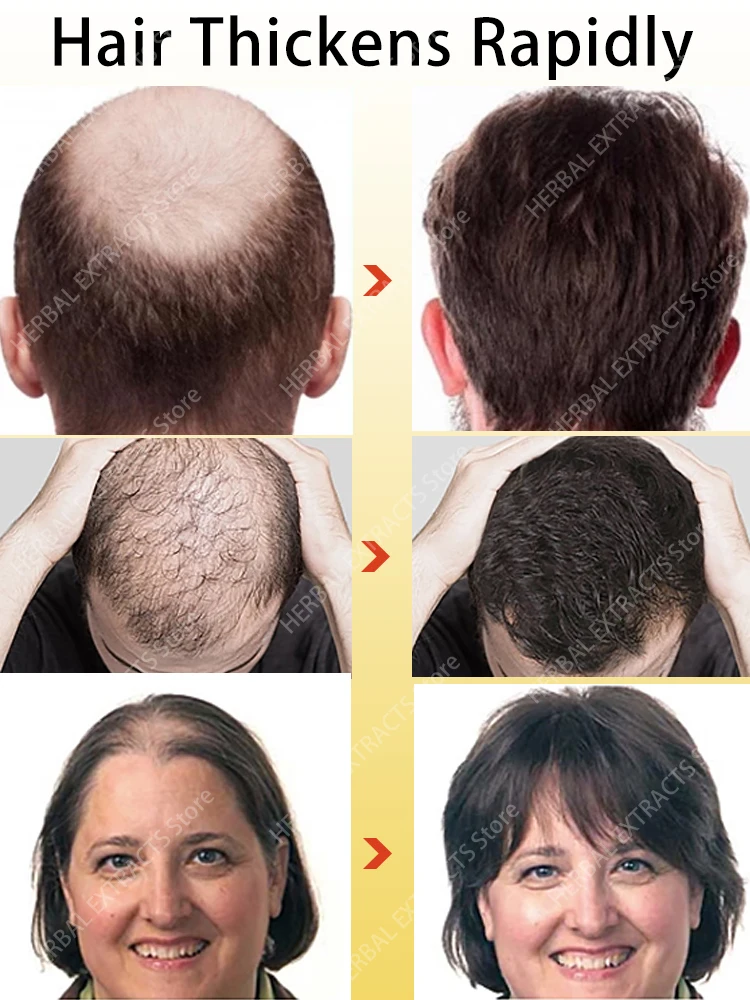 

Hair Growth Products Biotin Hair Oil Fast Regrowth Anti-Hair Loss Serum Thickener Scalp Treatment for Men Women Hair Care
