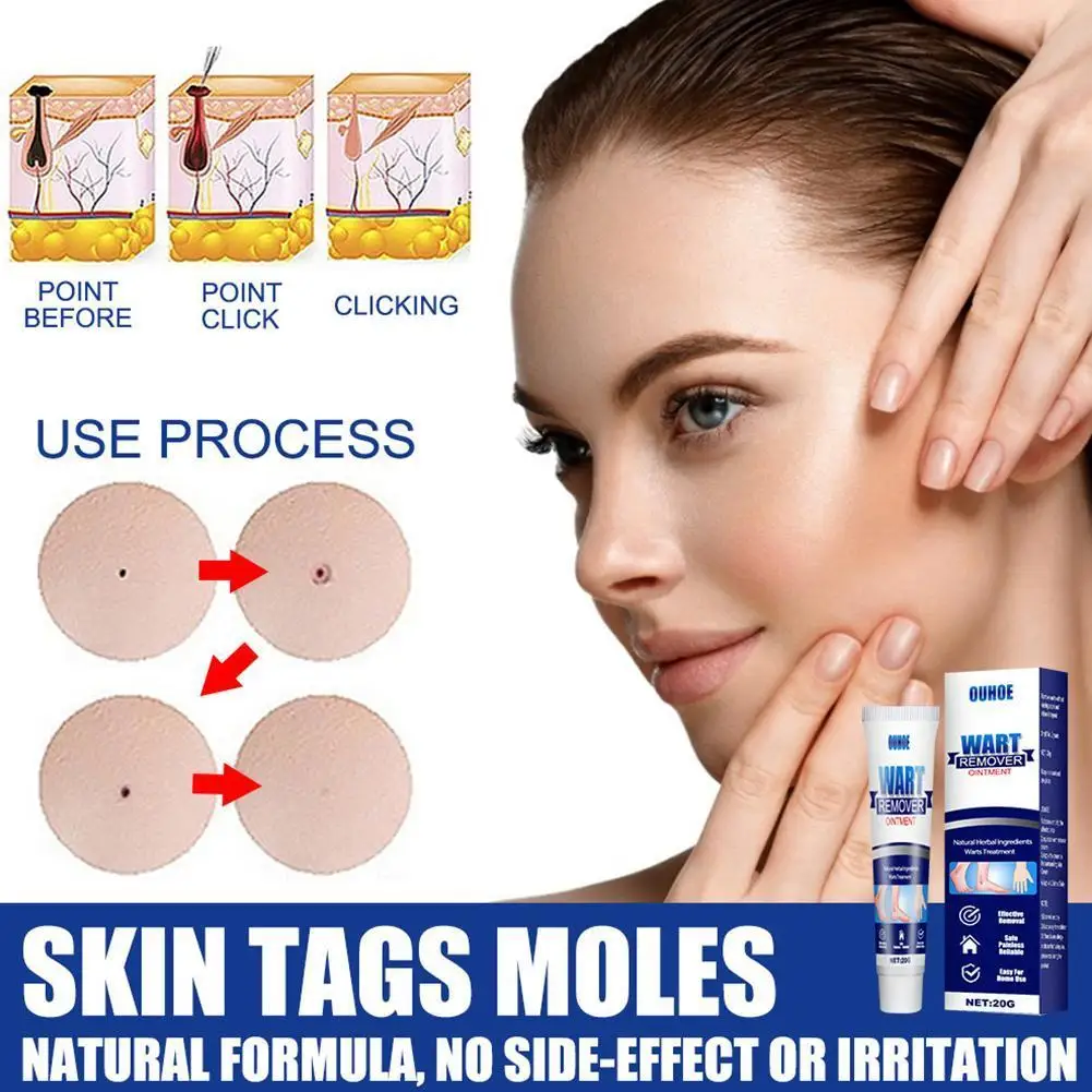 

20g Warts Remover Antibacterial Ointment Wart Treatment Cream Skin Tag Remover Herbal Extract Corn Plaster Warts Ointment