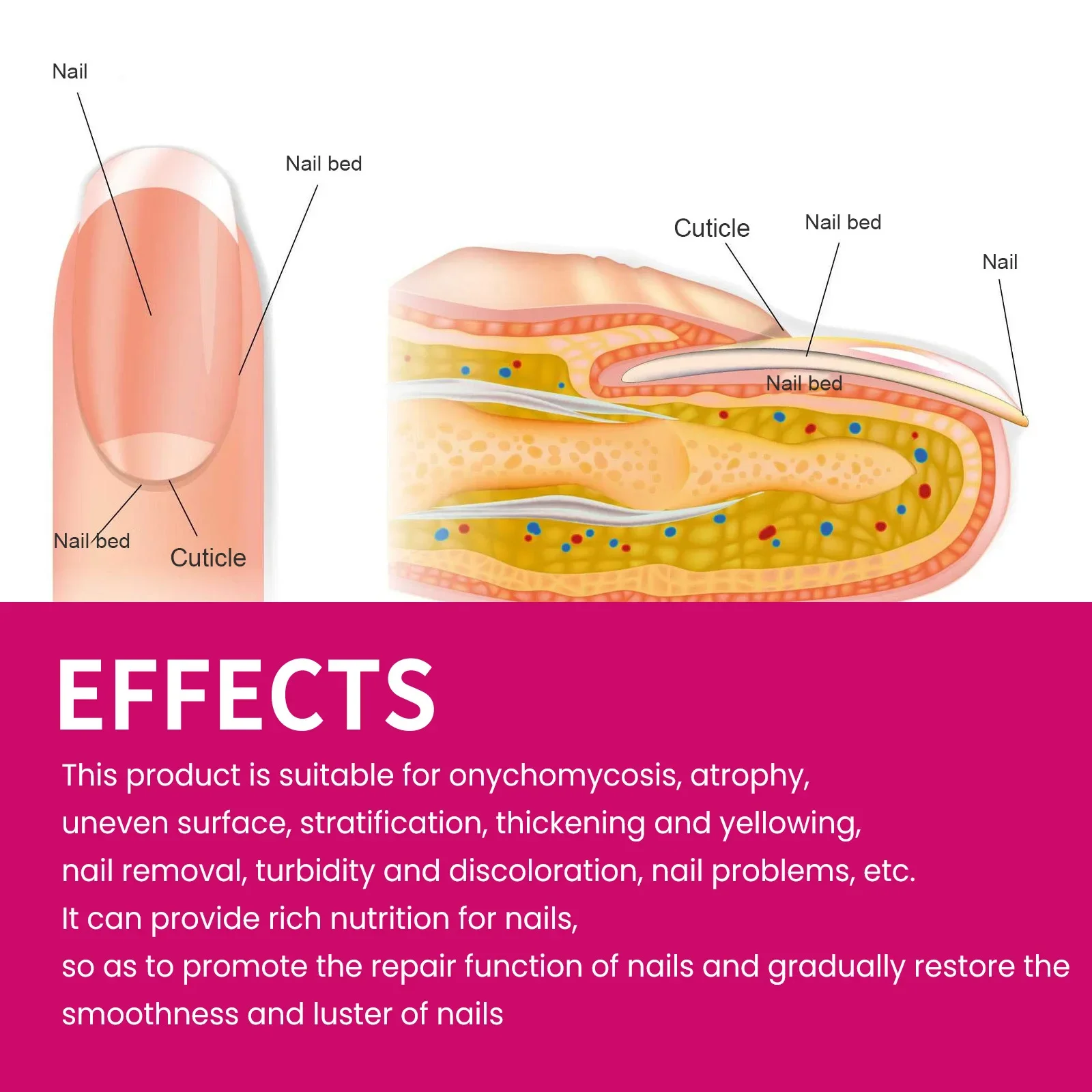 Сыворотка для восстановления ногтей имбирное удаление грибков против паронихии