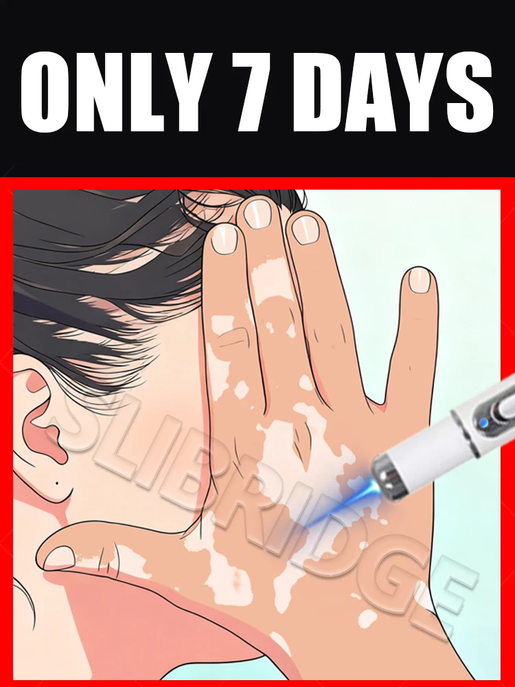 

2025 New Upgrade Blue light pen Solve Vitiligo Tool