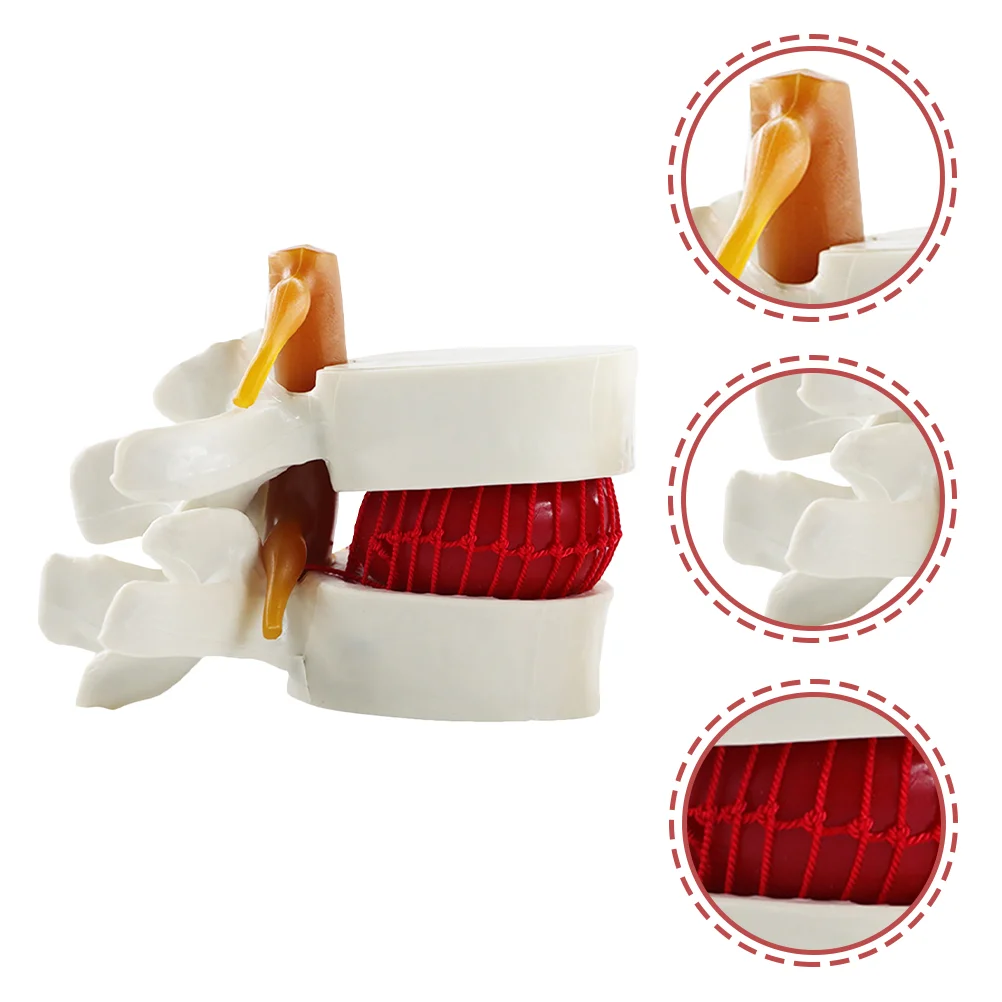 

Intervertebral Disc Model Anatomical Lumbar Herniation Mannequin Demonstrating Spine Teaching Human