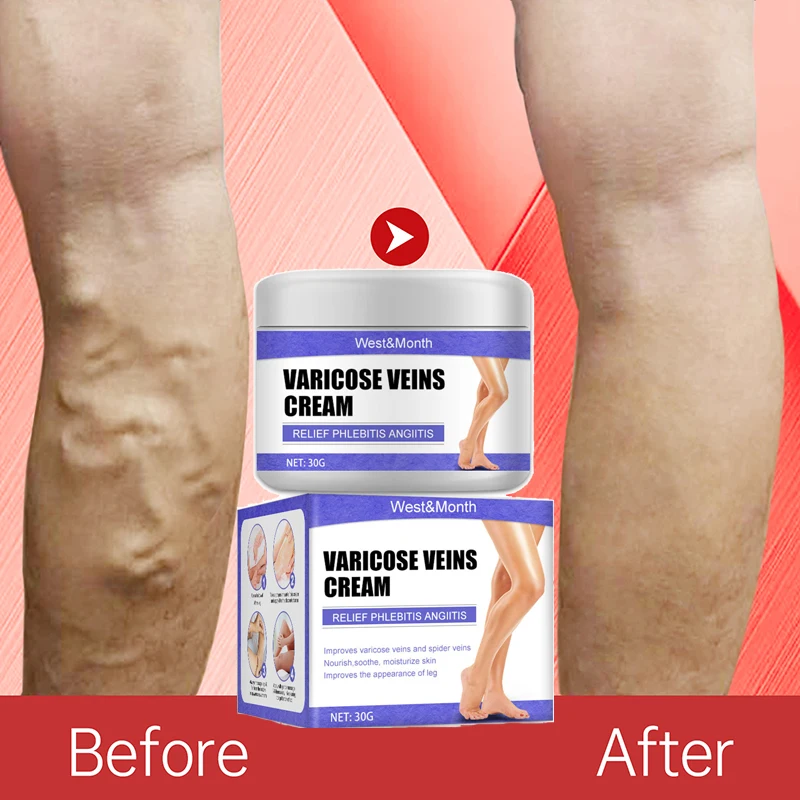 

Эффективный крем для лечения варикозного расширения вен, облегчает усталость ног, раскрывает васкулит, флебит, паук, быстрое уход за телом