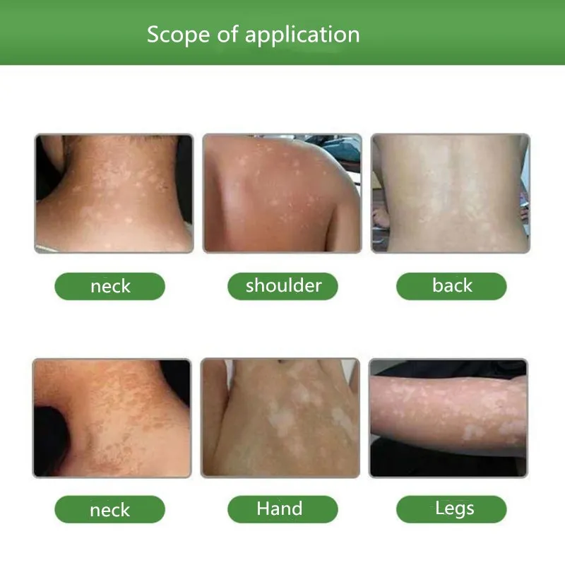 Лейкоплакия покрытие жидкий внешний ремонт жидкость витилиго