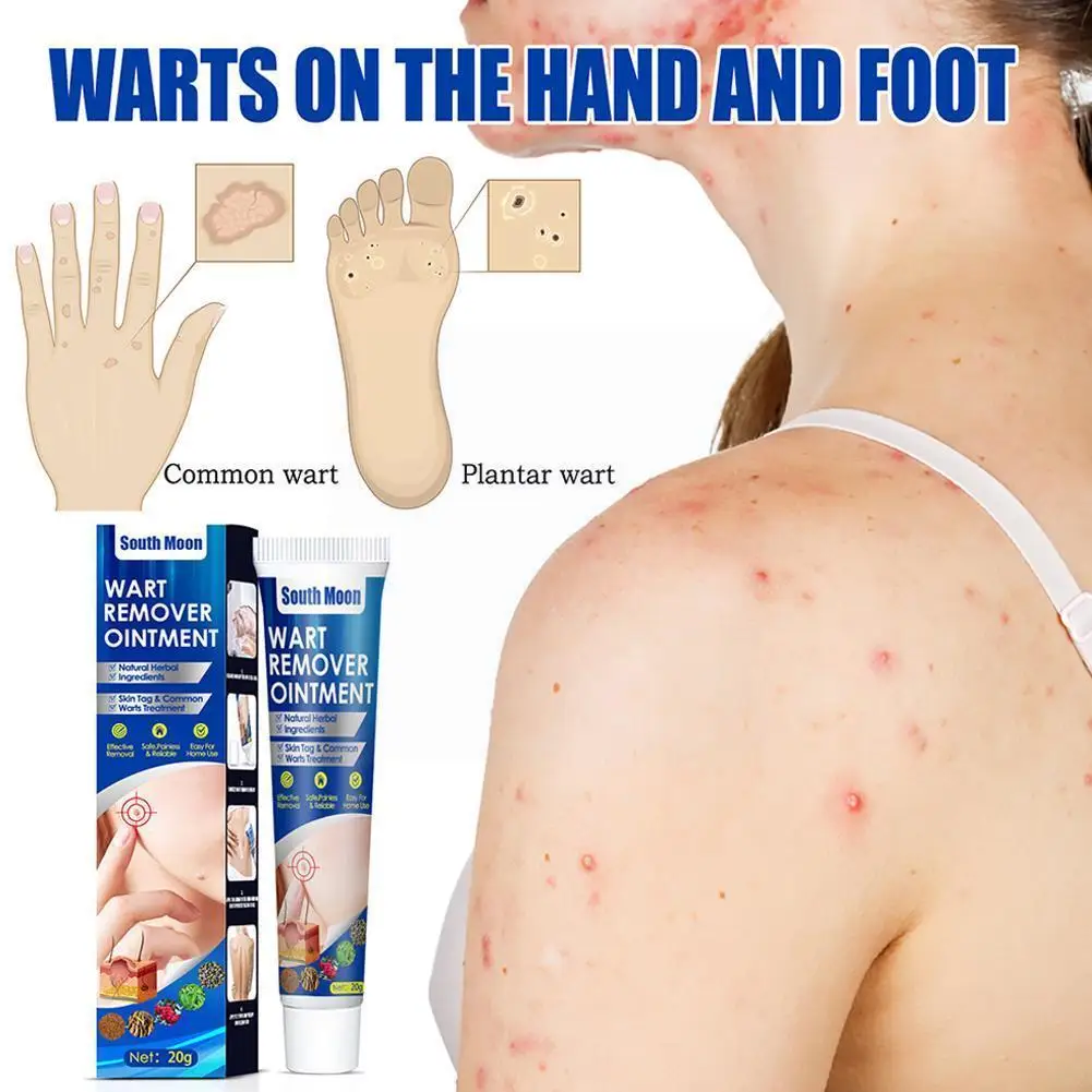 

Warts Remover Cream Skin Tag Remover Against Mole Antibacterial Wart Corn Extract Treatment Plaster Herbal Ointment C3U3