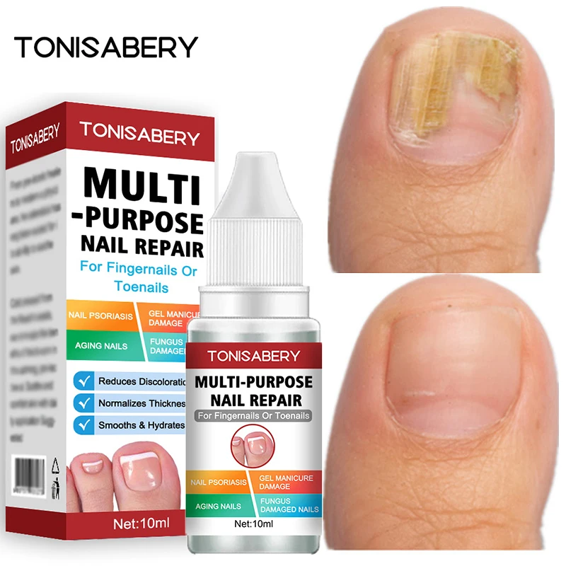 

Nail Fungus Treatment Serum Onychomycosis Paronychia Repair Gel Anti Infection Toe Fungal Hand Foot Care Essence Beauty Health