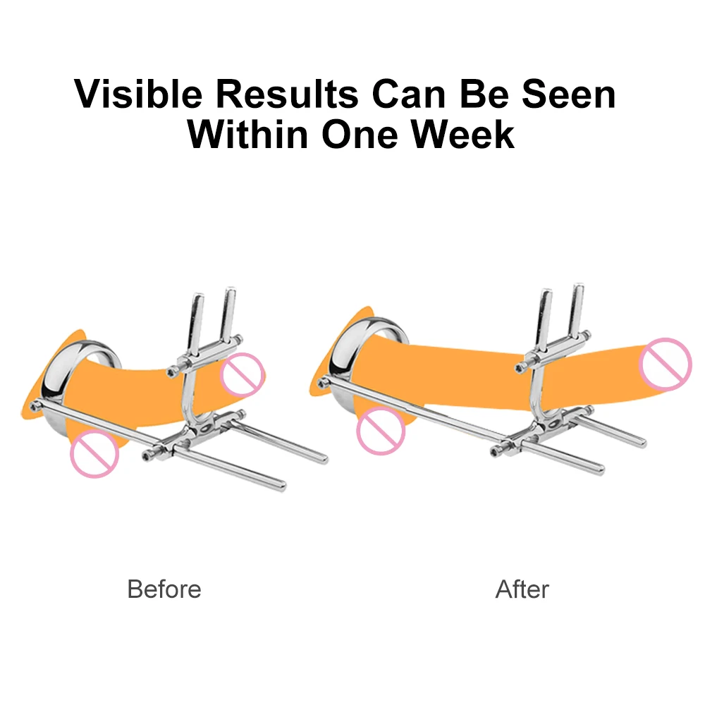 Рисунок 2 - Металлическое устройство для растяжки пениса