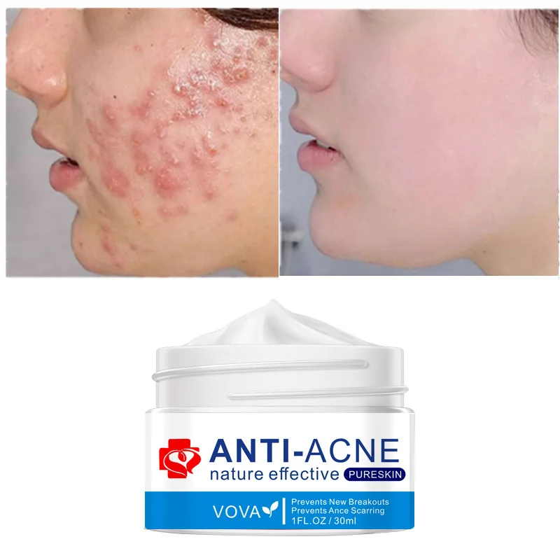 

VOVA Acne Face Cream Treatment Acne Lighten Acne Marks Oil Control Anti-inflammatory Whitening Brightening Anti-Acne Skin Care